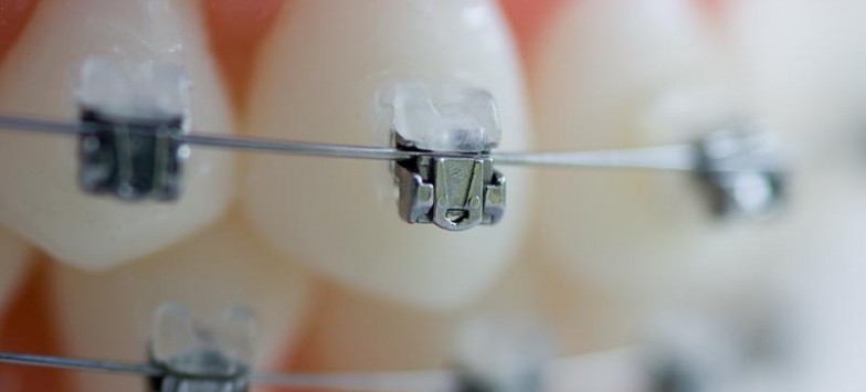 Брекеты – современное решение для достижения идеальной красоты зубов