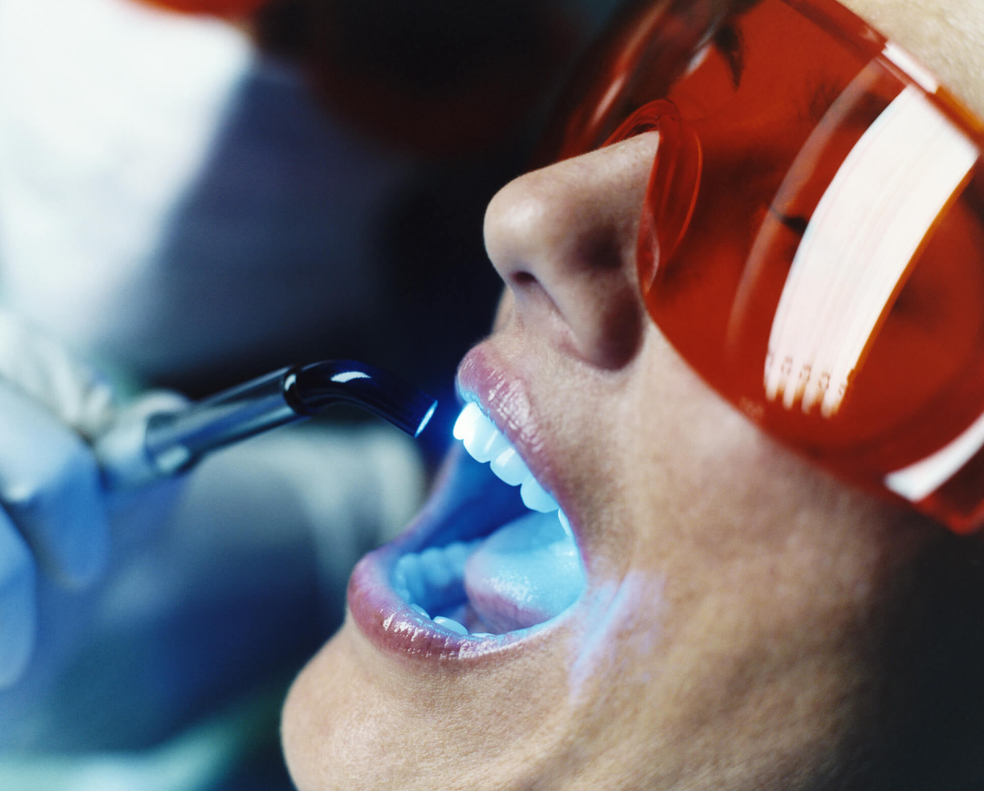 Отбеливание полости рта. Отбеливание зубов. Лазерное отбеливание зубов. Отбеливание у стоматолога. Отбеливание зубов в стоматологии.