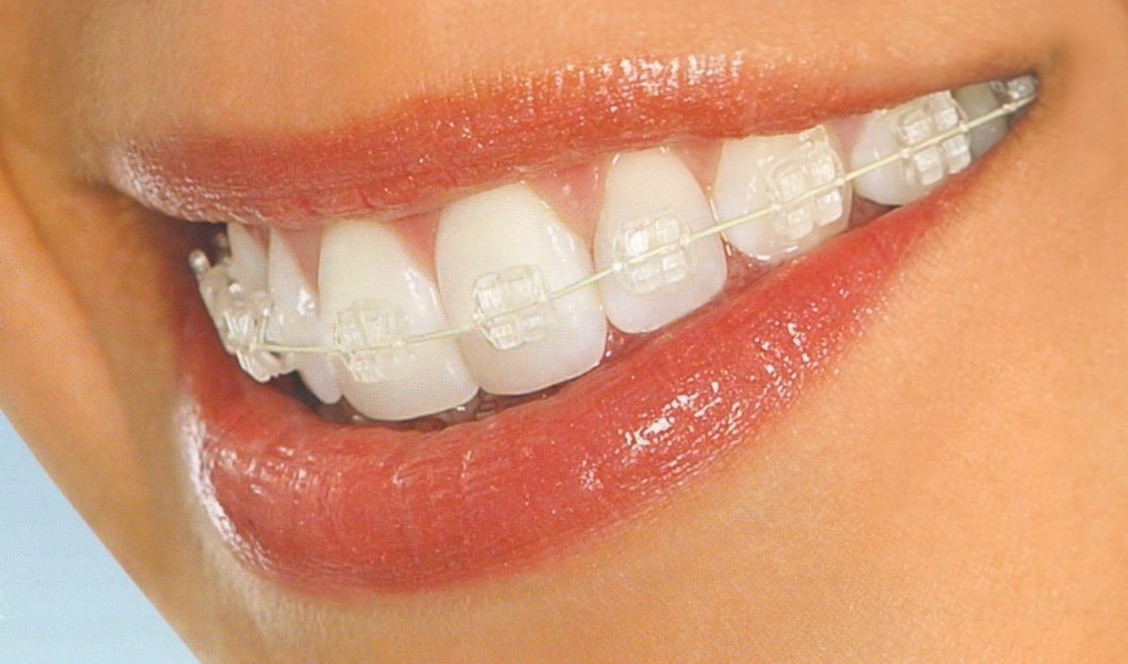 Современная ортодонтия: керамические брекеты