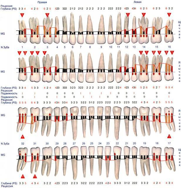 Пародонтальная карта онлайн
